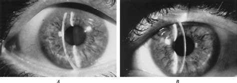 Figure 2 From Phototherapeutic Keratectomy For Superficial Corneal