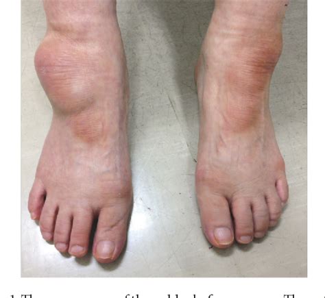 Bursitis Foot Treatment Altoons Designs