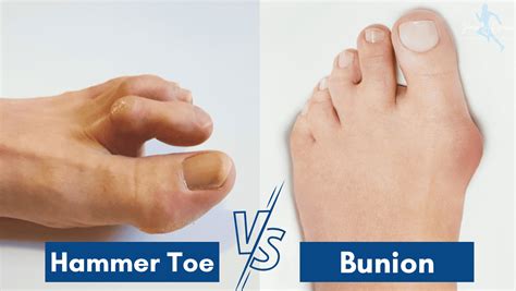 Corn Vs Bunion Bunion Vs Callus Causes Of Big Toe Pain