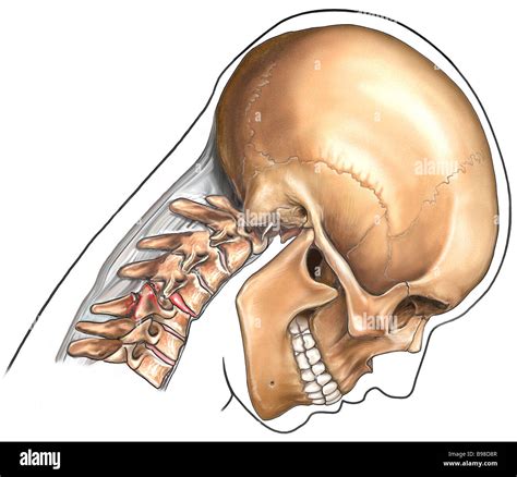 Cervical Spine Fracture C4c5 Stock Photo 22928327 Alamy