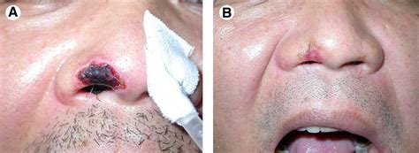 Preventing Pressure Sores Of The Nasal Ala After Nasotracheal Tube