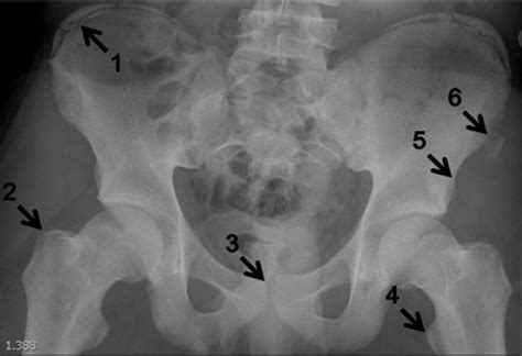 Hip Pain In An Adolescent After Injury While Playing Football The Bmj