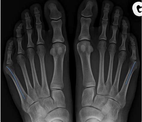 Why choose the bunion institute for your. Bunionette or Tailor's bunion - Foot and Ankle Institute