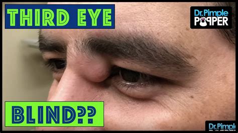 Dr Pimple Popper Squeezes Giant Cyst On Mans Eye Video Amc Medicaltalk The Best