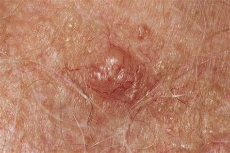 Photo Gallery Of Skin Cancer By Type