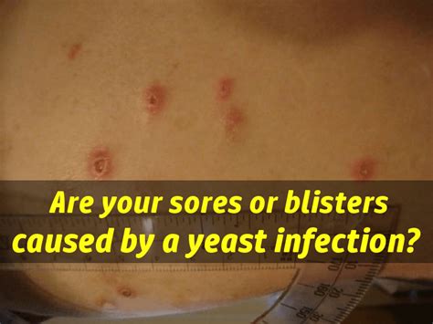 Yeast Infection Sores Blisters What Do Yeast Infection Sores Look Like
