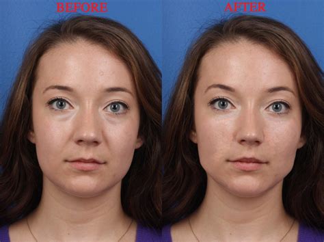 Here's how to achieve the v shaped look without surgery. Visual Plastic Surgery - Business Insider