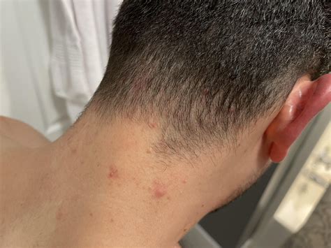 Skin Concerns Bumpsirritation On Back Of Neckhairline Please Help