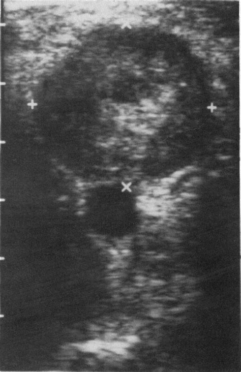 Case 49 1991 — A 46 Year Old Man With A Mass In The Popliteal Fossa Nejm