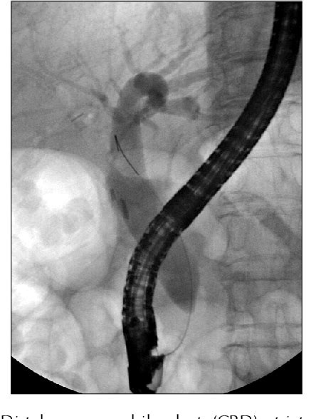 Table 1 From The Efficacy And Safety Of Fully Covered Self Expandable Metal Stents In Benign