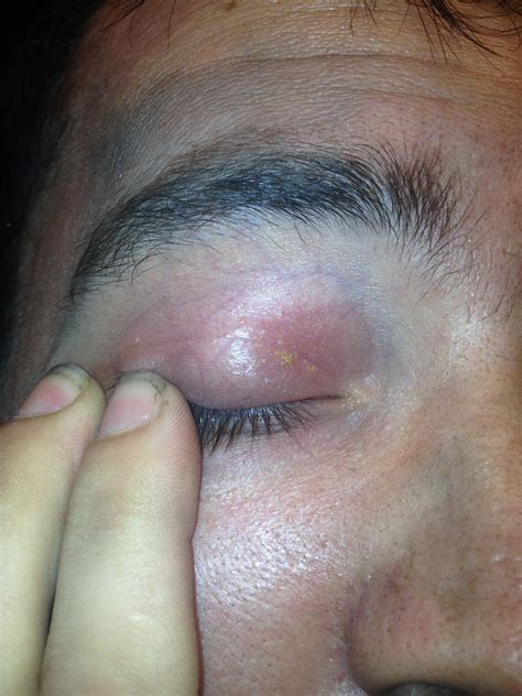 I Have A Rash On My Eyelid It Has Been Recurring For About