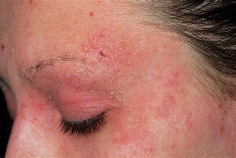 Eczema On A Girls Face Photograph By Dr P Marazziscience Photo Library