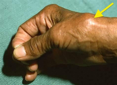 Osteoarthritis Carpometacarpal Cmc Joint Of Thumb Hand Surgery