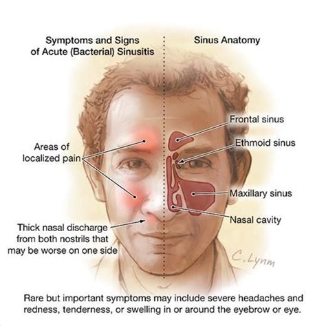 Acute Sinusitis Sinus Infection Remedies Sinusitis Sinus Remedies