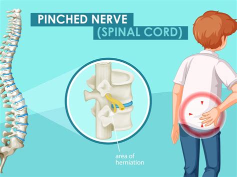 How Do You Fix A Pinched Nerve In Your Back Metro Health Nyc