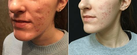 Acne Scar Subcision With Filler Before And After Photos New Jersey Reflections Center
