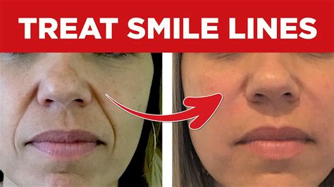 How To Get Rid Of Smile Lines Fade Smile Lines Nasolabial Folds