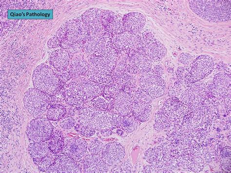 All Sizes Qiaos Pathology Lobular Carcinoma In Situ Lcis Flickr Photo Sharing
