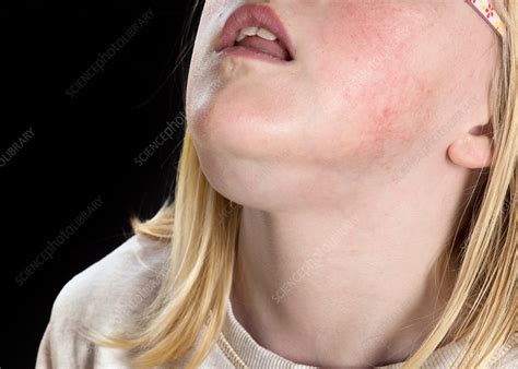 Swollen Chin Stock Image C0382318 Science Photo Library
