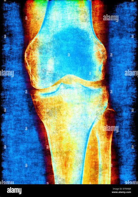 Normal Knee X Ray Hi Res Stock Photography And Images Alamy