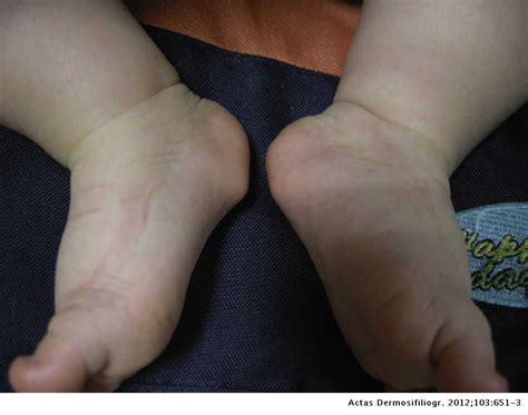 Precalcaneal Congenital Fibrolipomatous Hamartoma Actas Dermo