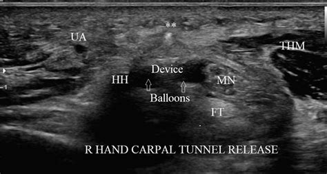 Cureus Office Based Carpal Tunnel Release Using Ultrasound Guidance