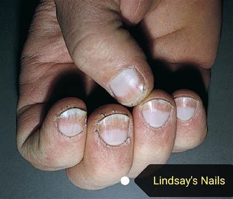 Common Nail Findings Associated With Diseases