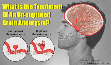 Unruptured Brain Aneurysm Treatment The Goal Of Treatment For Both