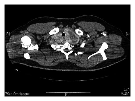 Axial Ct Scan With Contrast At The Level Of T2 Showing An Enlarged