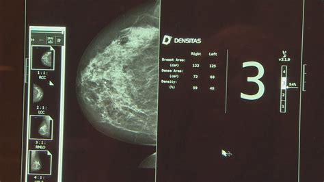 Breast Density Results Must Be Shared With Patients Say Advocates