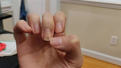 Nail Bed Damage Healing Youtube