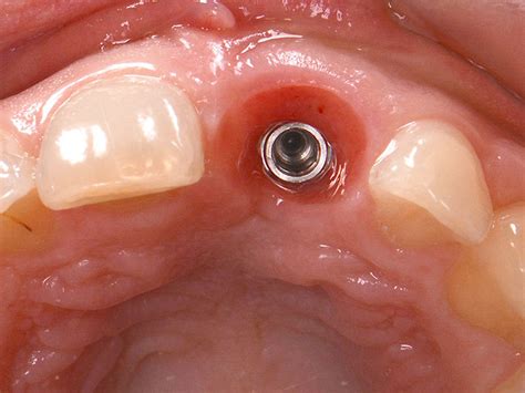 Implant Soft Tissue Management Definition Of Implant Soft Tissue