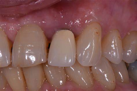 Case Challenge Restoration Of Aged Or Imperfect Teeth