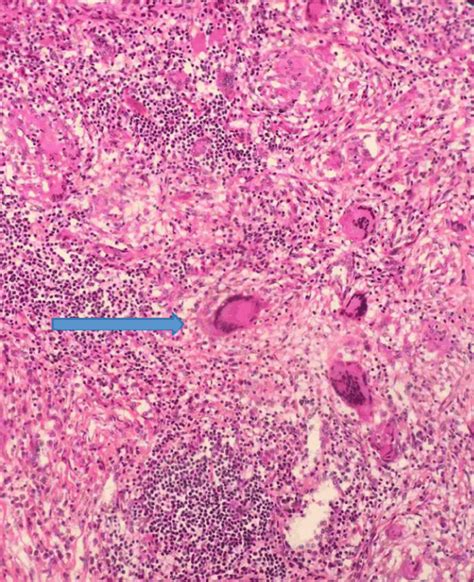 Multinucleated Giant Cell Can Be Seen Under High Power Field With