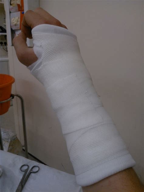 How to know if you have a sprained wrist. broken wrist fizzeo - what should I expect?? - Singletrack ...