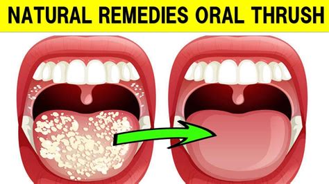 How To Treat Oral Thrush With Natural Remedies Youtube