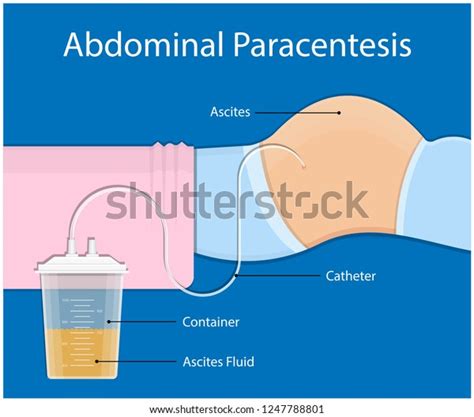 Ascites Paracentesis Medical Procedure Diagnostic Abdominal Vector De