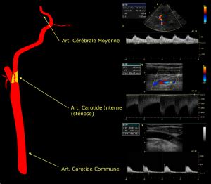 Le Profil D Coulement Sanguin Ultrasonographie Echographie