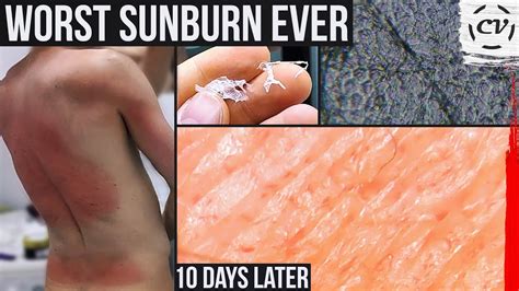 Sunburned Skin Under A Microscope Flawed Youtube