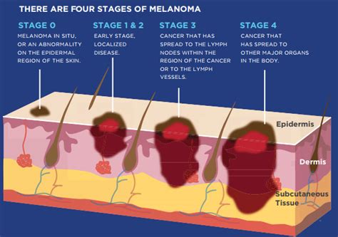 Stage 3 Melanoma Melanoma Stage 3 Prognosis Livestrongcom