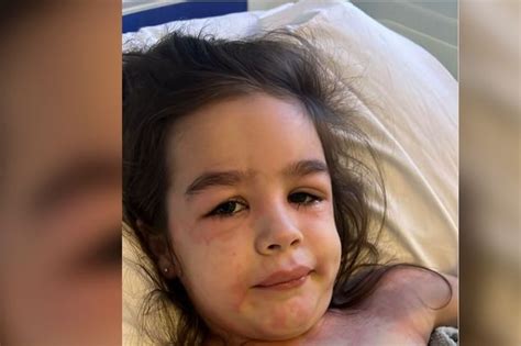 Mums Warning After Daughters Rash Turns Out To Be Sign Of Strep A Liverpool Echo