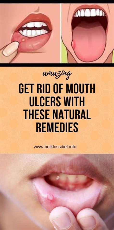If you have yellow or red bumps on your tongue, you could be suffering from a common condition called transient lingual papillitis, which is sometimes your article concerning a sudden appearance of a small pimple on my tongue has eased my mind and given me a couple of solutions as to how not to. Get Rid Of Mouth Ulcers With These Natural Remedies in ...