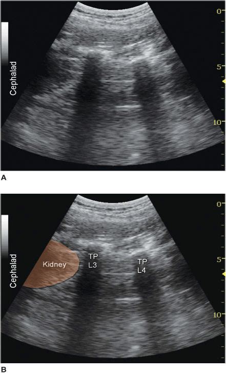 Ultrasound Of The Lumbar Paravertebral Space And Considerations For