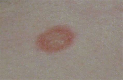 Round Dry Patches On Skin Not Itchy Atopic Dermatitis Symptoms