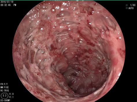 潰瘍性大腸炎は主に粘膜と粘膜下層を侵し、びらん や潰瘍 を形成する大腸の炎症性の病気です。 直腸は必ず炎症を起こします。 原因は不明ですが、ストレス、免疫異常が関係していると考えられています。 Images of 大腸炎 - JapaneseClass.jp
