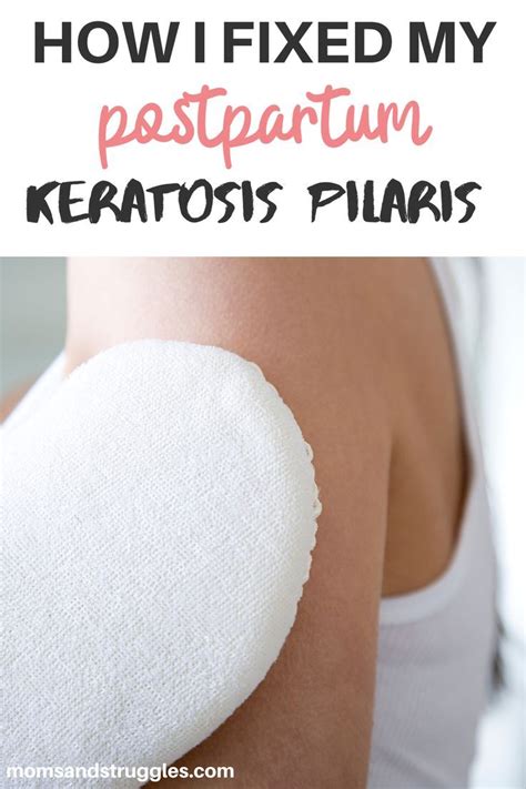 Fastest Way To Get Rid Of Keratosis Pilaris • Moms And Struggles In