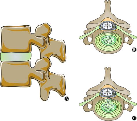 A The Intervertebral Discs Firmly Connect The Upper And Lower
