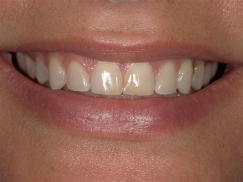 Esthetic Correction of Failed Color Match - McFarlane Dental