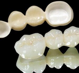 What is the process for getting a dental bridge? Dental Cercon/Zirconium Crown and Bridge (China Manufacturer) - Personal Care Appliance - Home ...