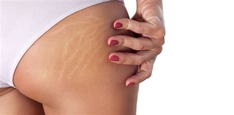 Stretch Marks Treatments Chicago Well Integrative Medicine